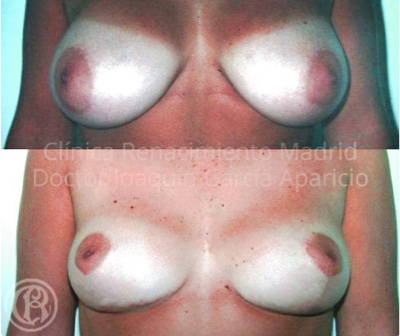 Bild des realen Falles vor und nach der Brustverkleinerung Klinik Renaissance Madrid 15