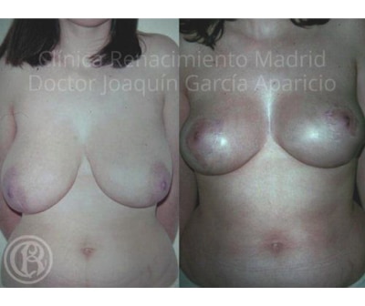 صورة لحالة حقيقية قبل وبعد عيادة تصغير الثدي نهضة مدريد 3