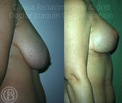 realer Fall vor und nach der Brustverkleinerung Klinik Renaissance Madrid 4