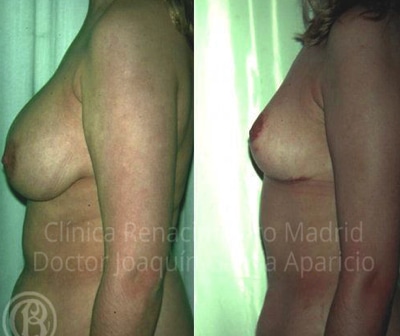 realer Fall vor und nach der Brustverkleinerungsklinik Renaissance Madrid 5