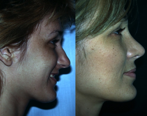 Bild der Nasenkorrektur Nasenkorrektur vor und nach der Renaissance-Klinik Madrid 6