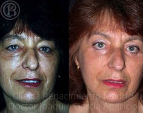 Bild der Augenlidoperation Blepharoplastik vor und nach der Renaissance der Klinik Madrid