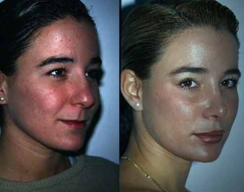 imagen de cirugia de pomulos malaroplastia antes y despues clinica renacimiento madrid 2