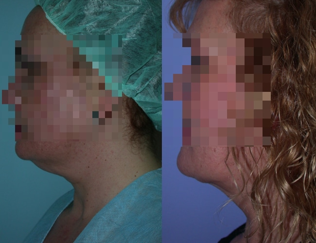 image of clinic renaissance madrid Double chin liposculpture real case before and after 12