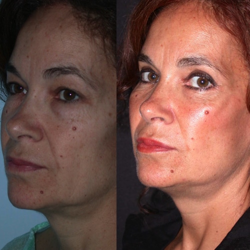 imagen de clinica renacimiento madrid lifting facial caso real antes y despues 1