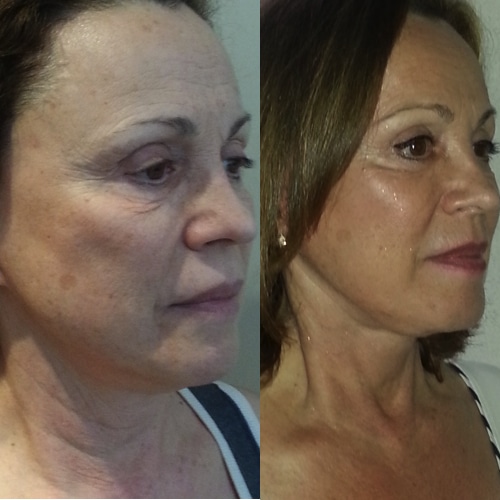 imagen de clinica renacimiento madrid lifting facial caso real antes y despues 11
