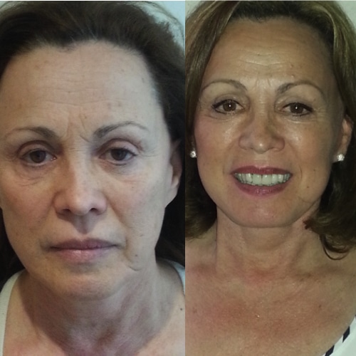 imagen de clinica renacimiento madrid lifting facial caso real antes y despues 12