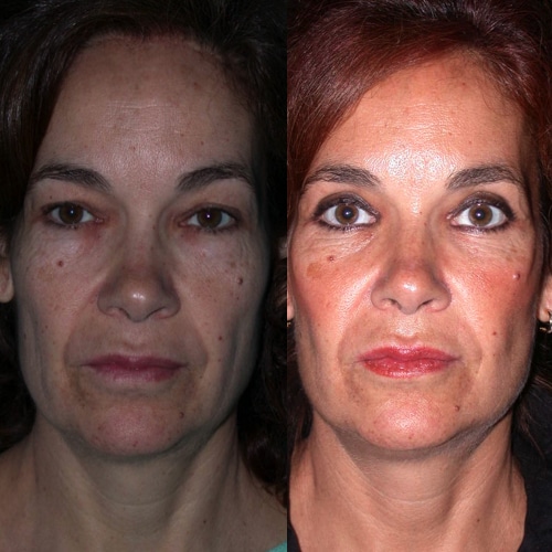 imagen de clinica renacimiento madrid lifting facial caso real antes y despues 3