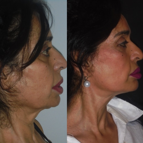 imagen de clinica renacimiento madrid lifting facial caso real antes y despues 7