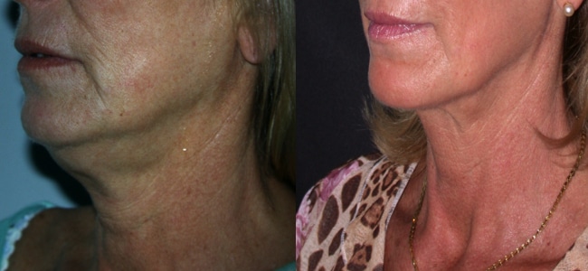 imagen de clinica renacimiento madrid rejuvenecimiento de cuello caso real antes y despues 2