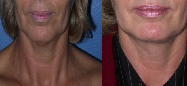 imagen de clinica renacimiento madrid rejuvenecimiento de cuello caso real antes y despues