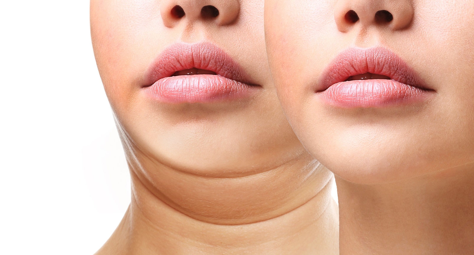 image of liposculpture of the double chin at the rendezvous clinic madrid and marbella