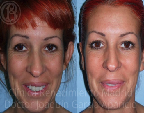 Bild der Ohr-Otoplastik vor und nach der Renaissance der Klinik Madrid