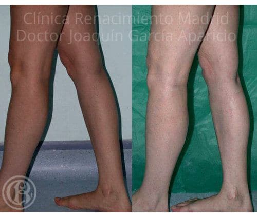 Bild der Prothese der Zwillinge Klinik Renaissance Madrid
