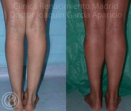 Bild der Prothese der Zwillinge Klinik Renaissance Madrid