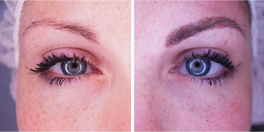 real case image micropigmentation of eyebrows clinic renaissance marbella