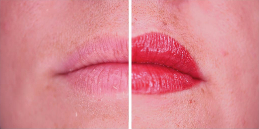 imagen de caso real micropigmentacion de labios clinica renacimiento marbella